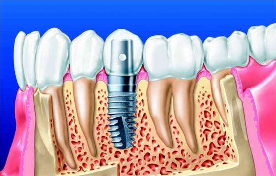 长沙种植牙