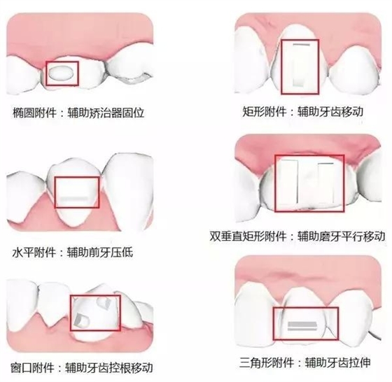 长沙隐形矫正