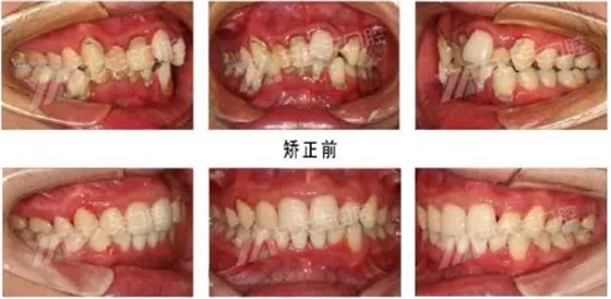 长沙牙齿矫正