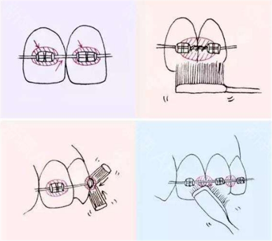 牙齿矫正后刷牙方法