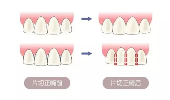 长沙牙齿矫正