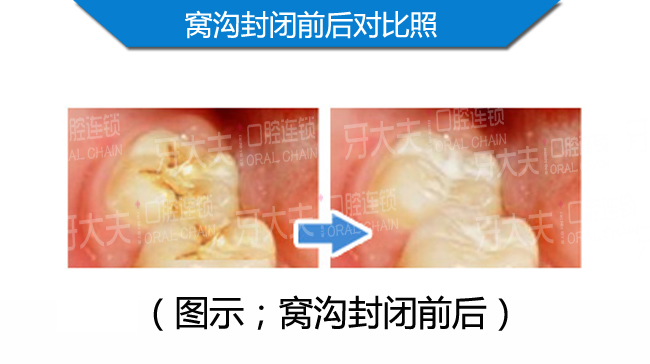 窝沟封闭案例对比.jpg