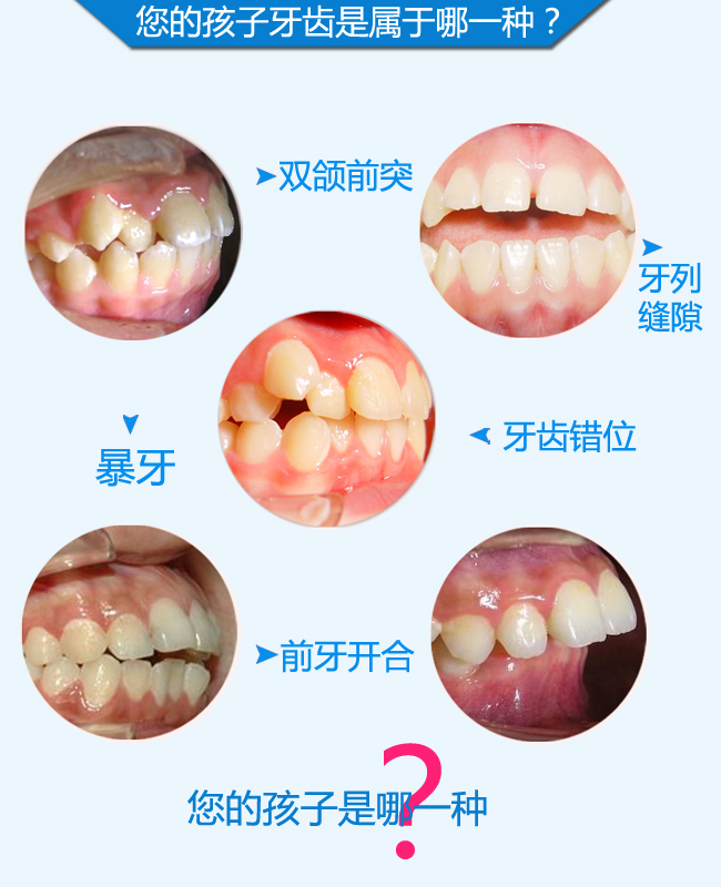 您的孩子牙齿是属于哪一种.jpg