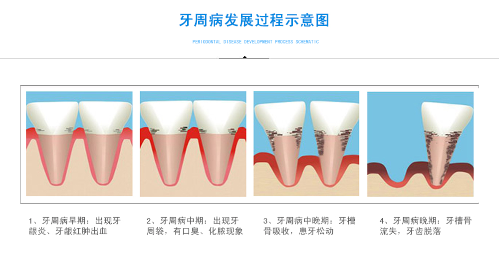 牙周病发展过程示意图.jpg