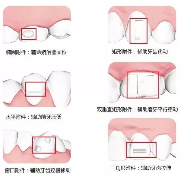 长沙隐形矫正